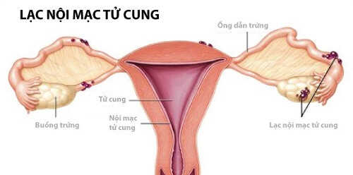 Lạc nội mạc tử cung